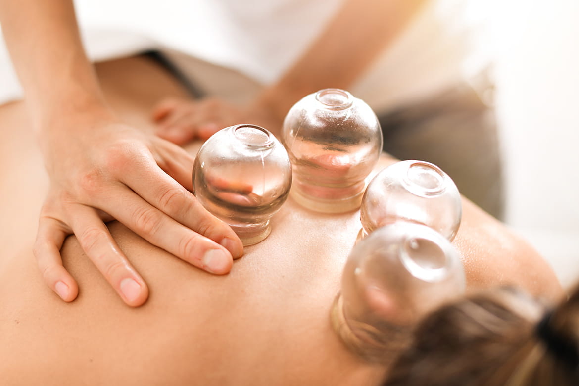 close up of cupping therapy cups creating suction on the skin
